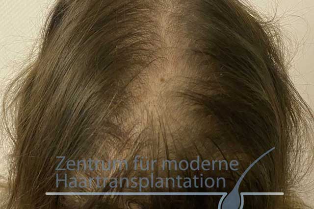 Diffuser Haarausfall bei Frauen