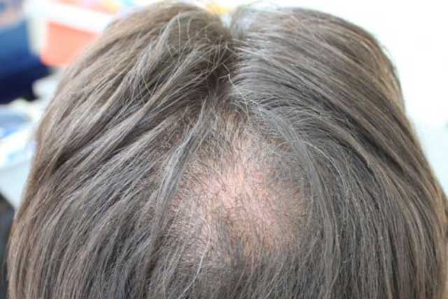 Alopezie I-FUE Haartransplantation