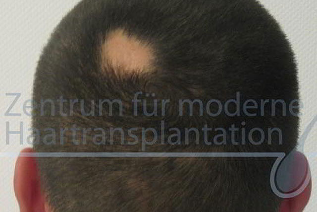 Kreisrunder Haarausfall - Kahler Herd