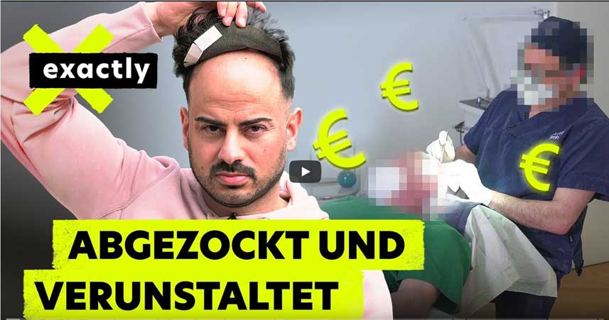 Pfusch und Betrug: Das Geschäft mit dem Haarausfall