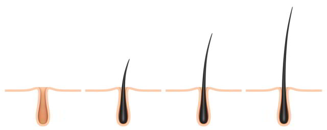 Die Haarwurzeln werden mit einer Pinzette eingesetzt