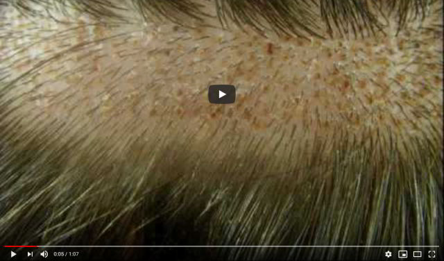 Video zur FUE-Haartransplantation