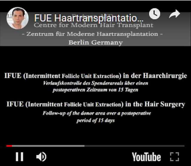 Narbenfreie Abheilung des Entnahmeareals nach I_FUE Haartransplantation