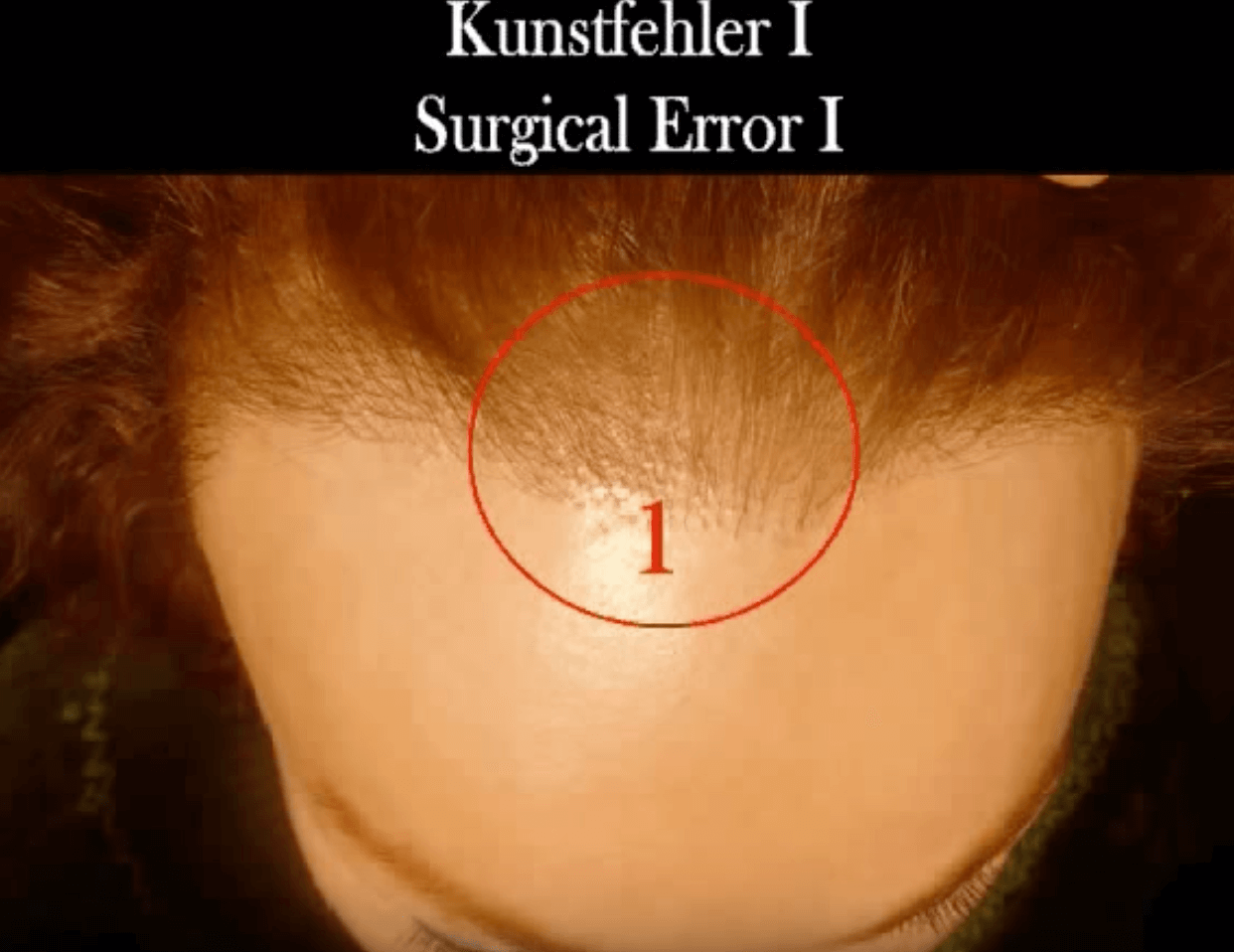 DE  Navigation überspringen Suchen    Erstellen   Avatarbild FUE Haartransplantation: Azar- der Spezialist für Haarkorrekturen in Berlin Tel. 030 20647418